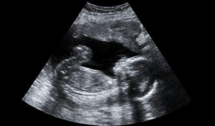 Mit mutat az ultrahang?