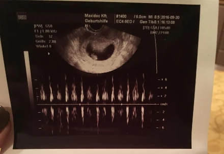 Terhesnapló10 - Liza: Dobog a szíve! (8. hét)