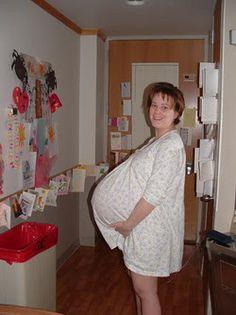 Ezek a csecsemők 9 héttel korábban születtek. Így néznek ki most 20 évvel később a világ első hetes ikrei