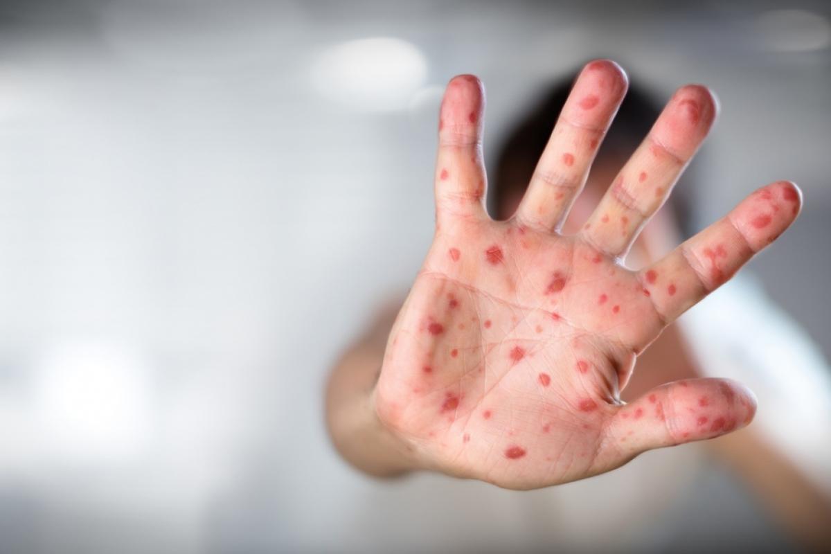 A gyerekek beoltásának megtagadására buzdítják a szülőket Romániában! Kanyaró