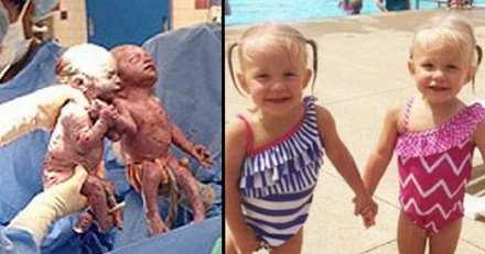 Öt év után is elválaszthatatlanok azok az ikrek, akik egymás kezét fogva születtek