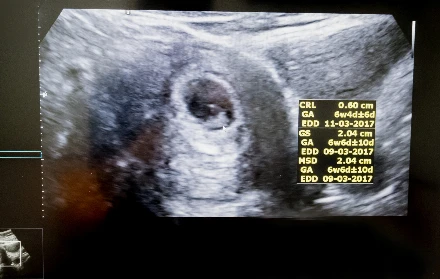 Miért nevezhető életnek már a magzati lét?