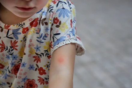 Mi jó kullancs ellen? Így védheted meg a gyerekedet és a családot a kullancscsípéstől