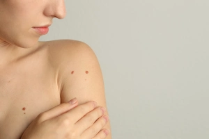 Anyajegy vagy melanoma? Így különböztetheted meg a kettőt egymástól