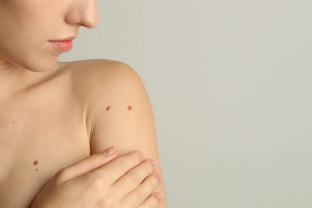Anyajegy vagy melanoma? Így különböztetheted meg a kettőt egymástól